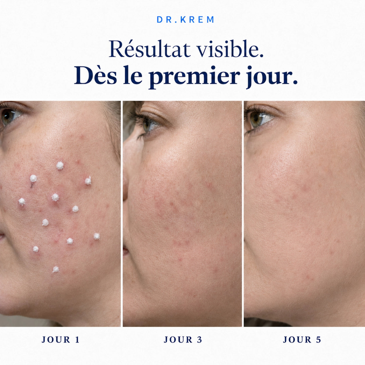 DR.KREM — Solution Acné Ciblée